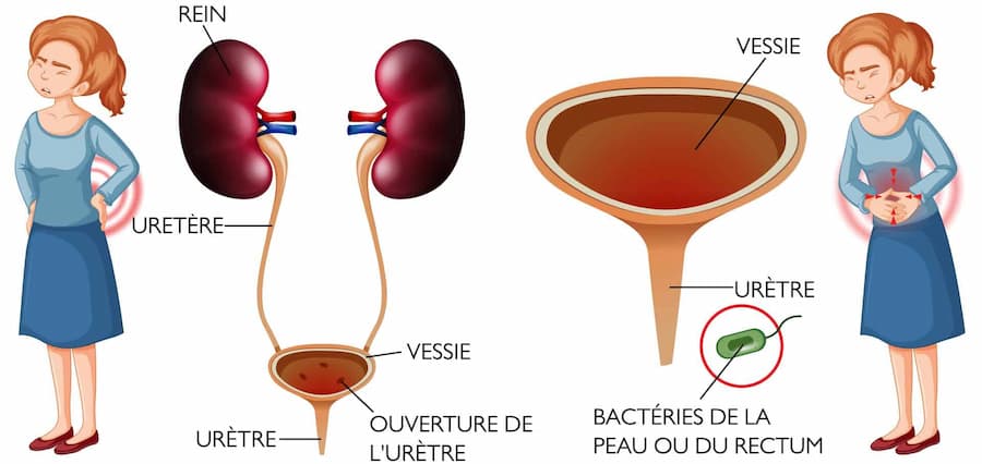 Schéma d'une cystite